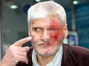 Maganda kurşunu ile hayatı karardı, yüz nakli için yardım bekliyor